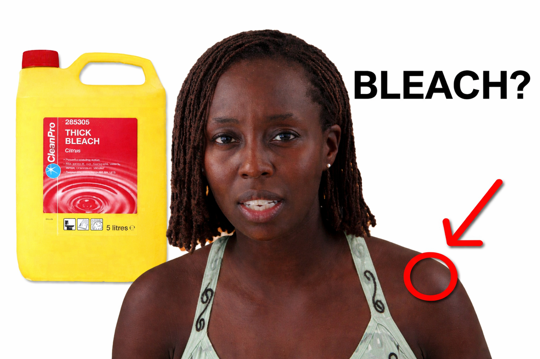 Vivienne Lamb next to a container of bleach with a red arrow pointing to her skin, referencing the practice of bleach baths for eczema treatment.
